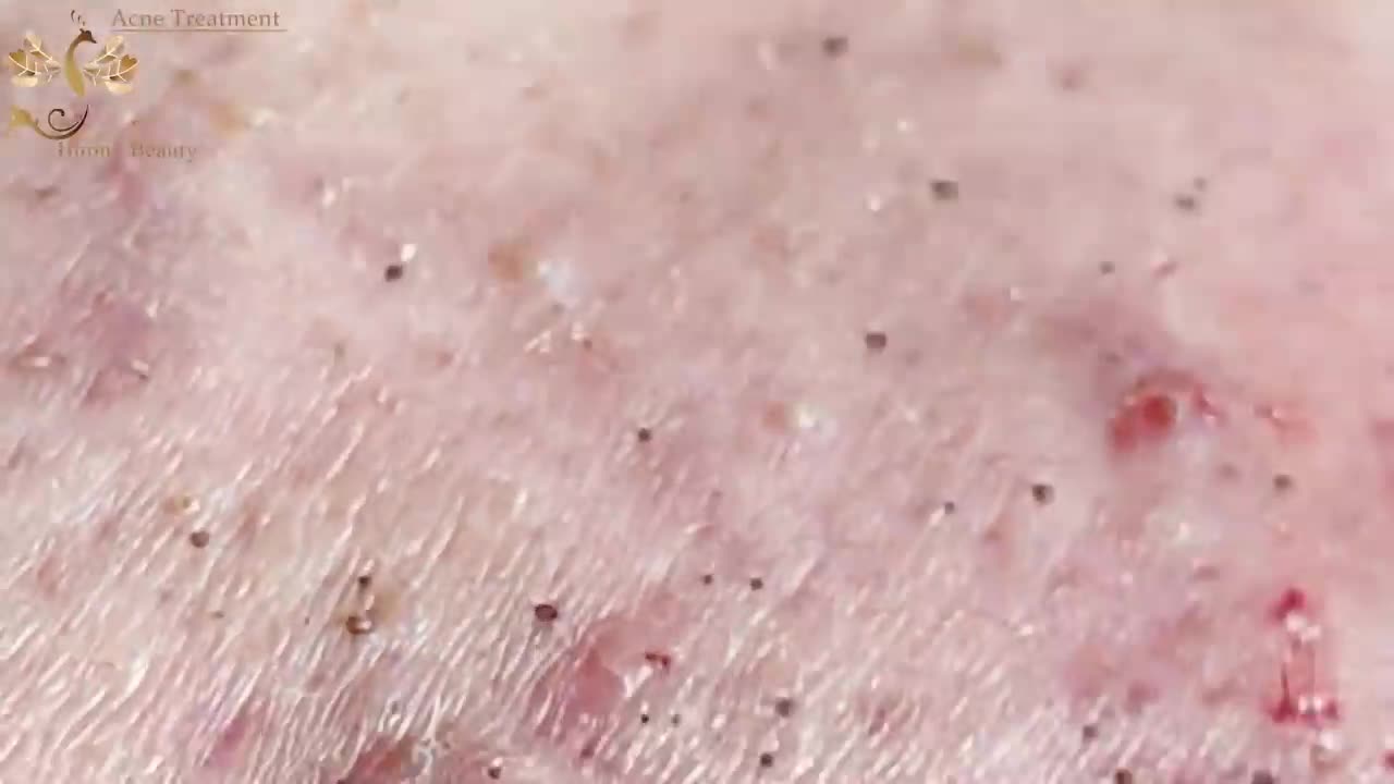 #150 | Acne Treatment Huong beauty - Part 2