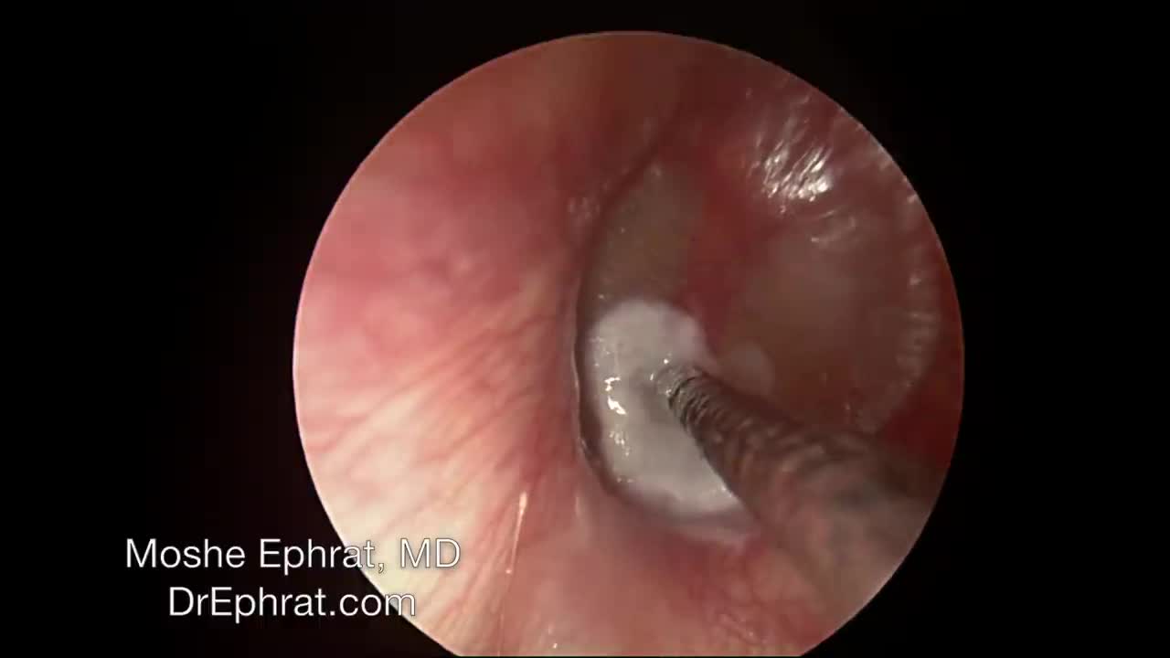 ENDOCSOPIC MUCOID OTITIS MEDIA DRAINAGE