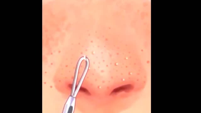 [ ASMR ] Nose Whiteheads Extraction Animation | Skin Cleaning #viral Skin Care Beauty