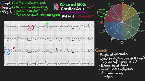 Understanding Cardiac Axis and Deviations - 12-Lead EKG