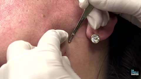 Pinching & Extracting Jaw Comedones Part 1! Dr Pimple Popper Satifies Nervous Patient