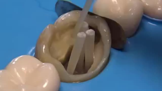 AMAZING dental caries treatment captured in 4k