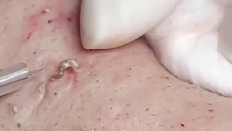 pimple popping