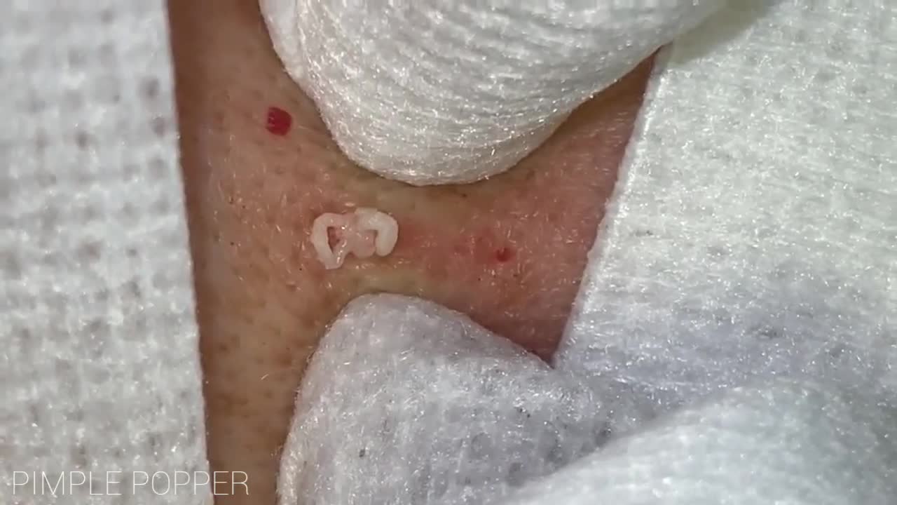 Satisfying Pimple Popping Videos #3