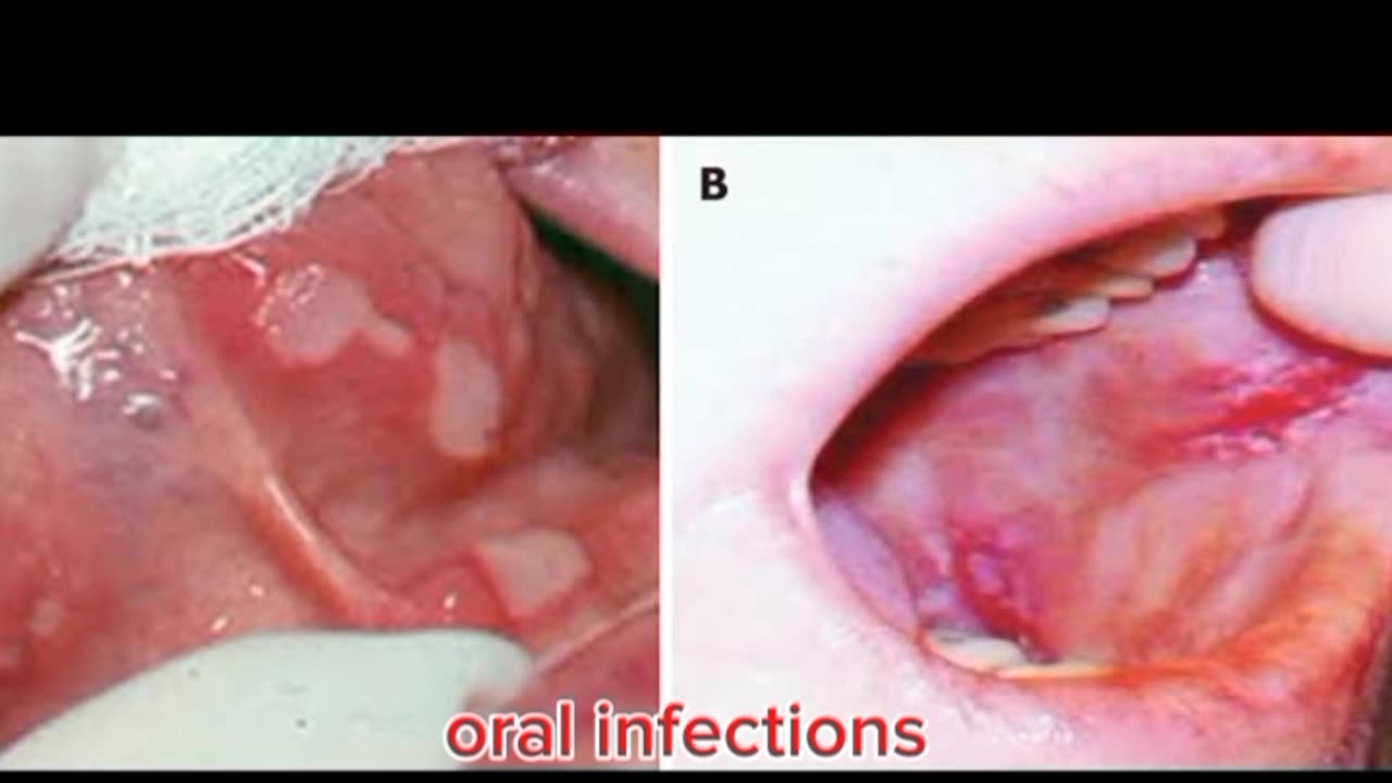 Oral complications of diabetes ( frequently visiting complaints)