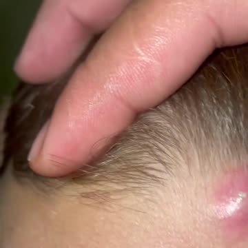 You'll love this #pimple #extraction #popping #skincare #cyst #whiteheads #blackheads