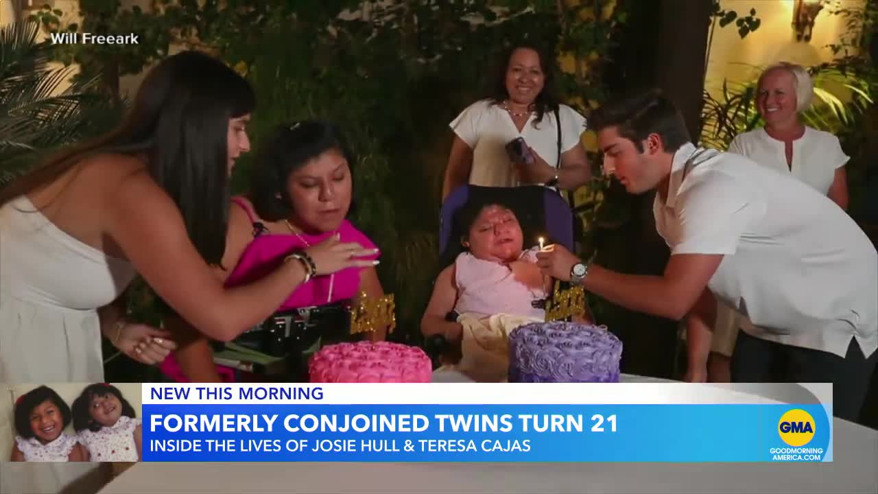 Formerly conjoined twins celebrate 21st birthday