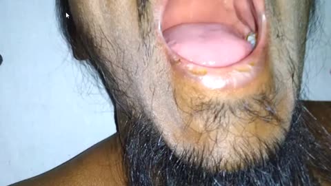 ST5.36 year old man with cough for 6 months Scenario