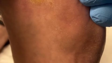 Very painful corn and callus removal by Australian Podiatrist