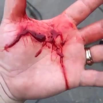 20 days after vax- blood clotting wildly