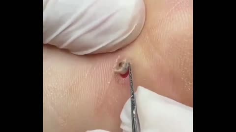 dr pimple popper blackhead