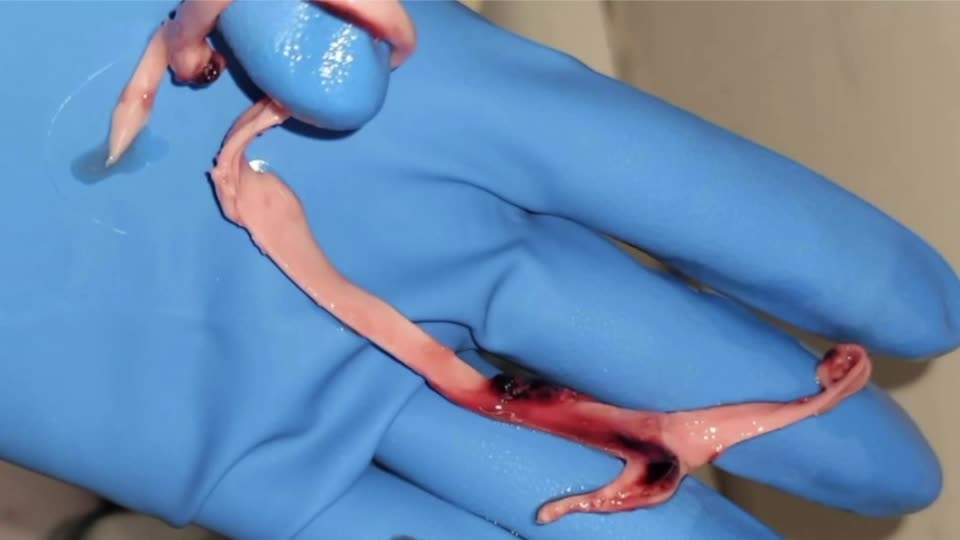 Died Suddenly Blood Clots