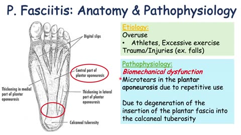 Plantar Fasciitis (Heel Pain) | Causes, Signs & Symptoms, Diagnosis, Treatment