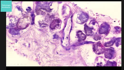 פתולוגיה של מקרי מוות מחיסונים והוכחה לפציעות מהחיסון ראו מה קורה בגוף של המחוסנים