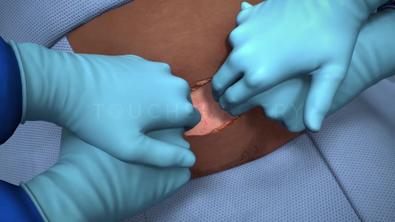 Steps to a Cesarean section, informational for expected parents