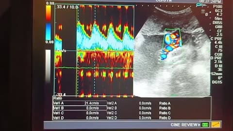 Female gender at 35_36 week with thin uterine scar and no labor pain l previous three l