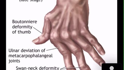 MRCPI Revision of rheumatology 1.mp4