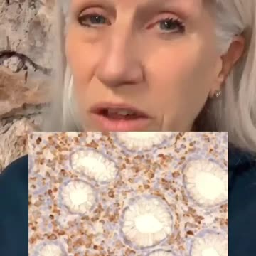 Doctors find covid jab spike proteins in middle of cancer cells