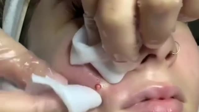beauticians squeeze a pimple