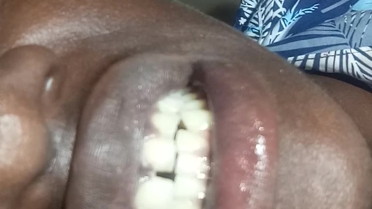 Broken tooth