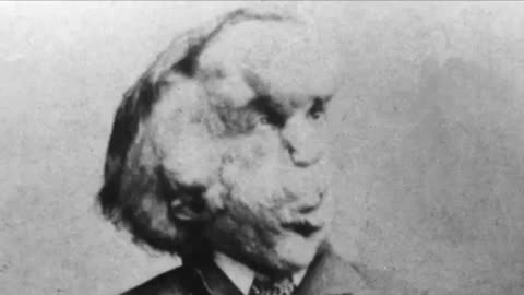 Joseph Merrick - The Elephant Man - By Their Fruits