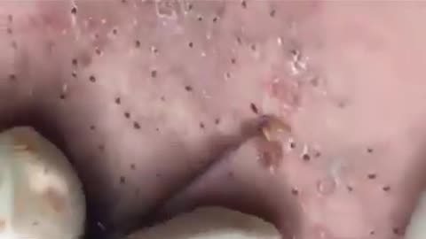 Blackheads removal 2