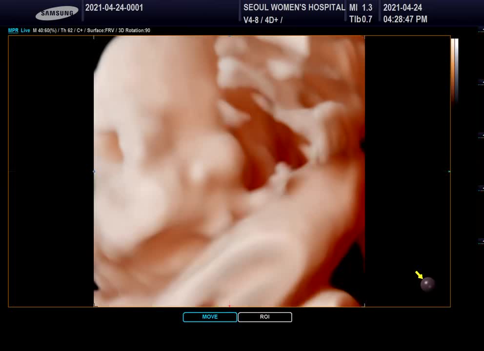 Ultrasonic video of a yawning baby.