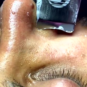 Newest pimple removal 2022 - Cystic acne extractions whiteheads new