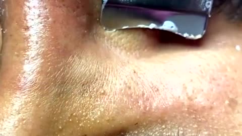 Newest pimple removal 2022 - Cystic acne extractions whiteheads new