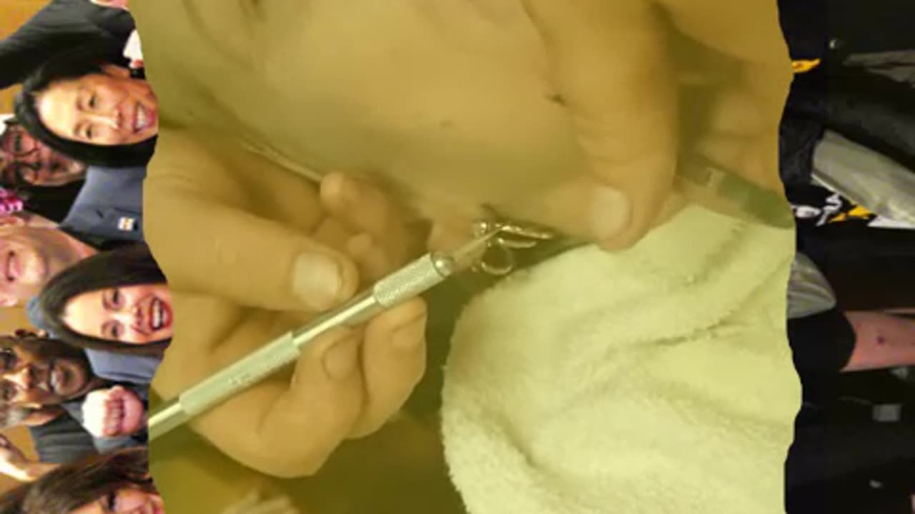 Pimple popping and blackhead