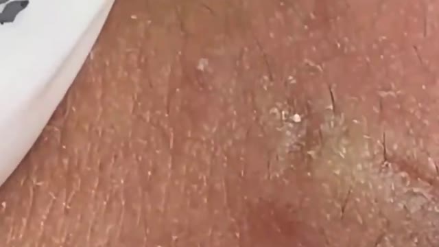 Giants Deep Blackheads, Whiteheads, Big Pimples, Hidden Acne Removal - Best Popping Videos #000015