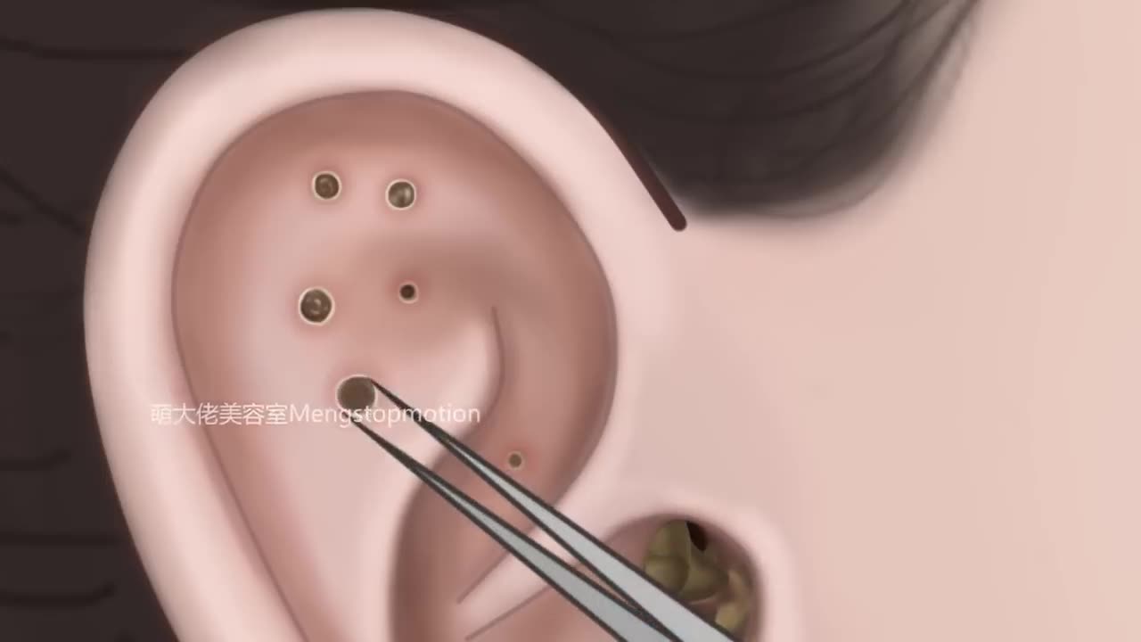 Ear infarction Remove treatment