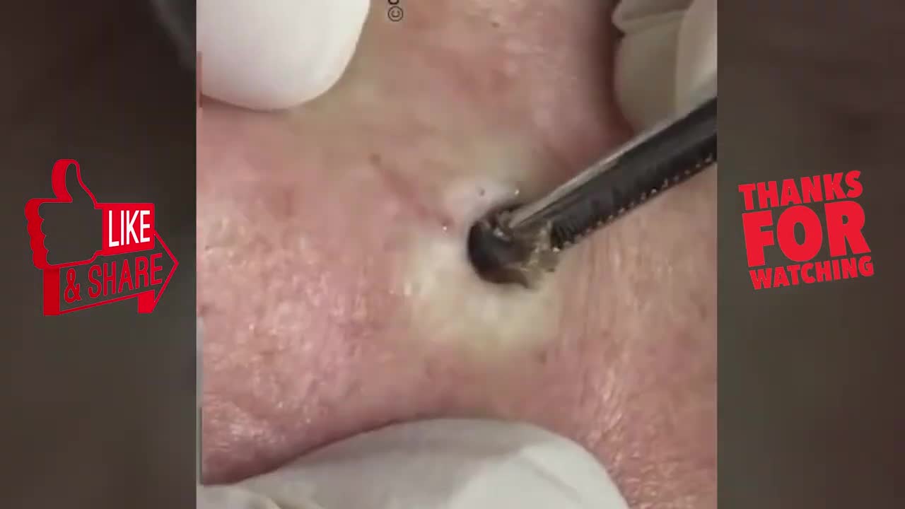 NEW PIMPLE POPPING VIDEOS 2021 WOW! NEW!