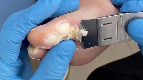 Removing dead skin from the foot