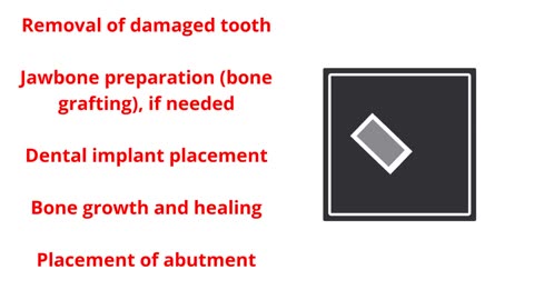 Paya Dental Implant in South Miami, FL