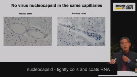 Dr.Sucharit Bhakdi about damage to the brain