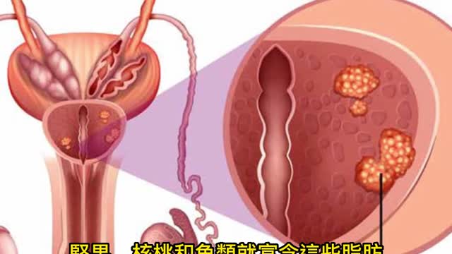 喝咖啡 降攝護腺癌風險