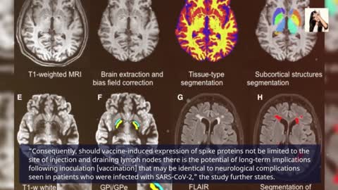 מחקר מקשר בין חיסוני הקורנה למחלת הפרקינסון ומוצא שחלבוני ספייק יכולים להגיע למוח תוך 30 דקות מהזריקה