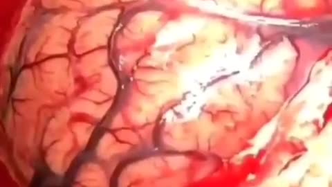 MRNA疫苗刺突蛋白會導致大腦血栓出現大量血塊