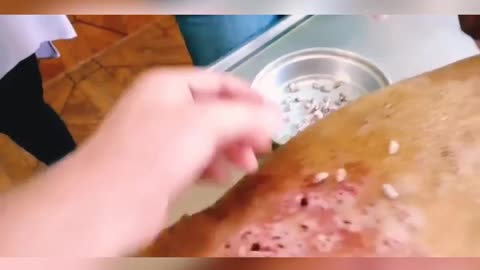 HUGE Botfly Maggot Removed -THERE ARE SO MANY!