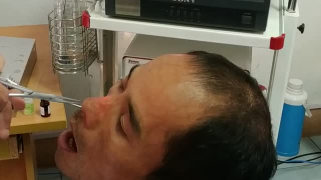 Doctor Retrieves Strange Creature From Man's Nose