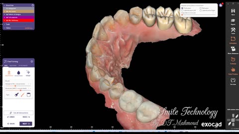 #design #naildesign #dental #dentaldesign #exocadexpert