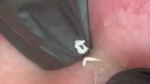 Removing blackheads 🤤