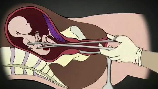 Dr who KILLED 1200 Babies with ABORTION Speaks Out!