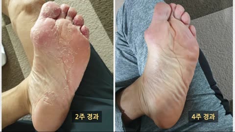 무좀완치 단! 한시간! Athlete's foot disease cure! step! 1 hours!