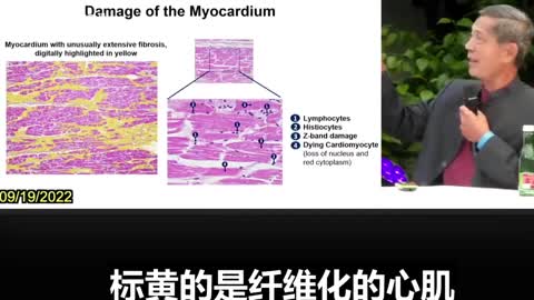 苏查瑞·巴克迪博士：新冠疫苗中的刺突蛋白会损害心肌细胞。