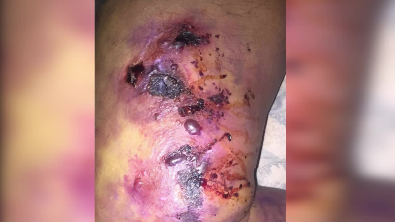 Necrotic Leg Wound Healed with The Universal Antidote