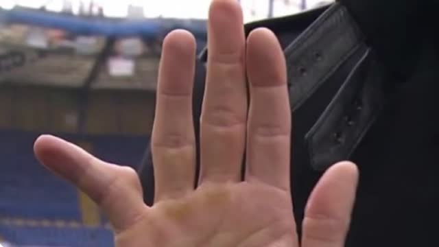 Goalkeeper’s finger after 21 years play