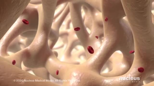 Anemia from Chronic Kidney Disease (CKD) Treatment.
