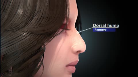 Rhinoplasty (Nose Job) | Step by step